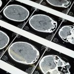 Mental Disorders Caused by Traumatic Brain Injuries
