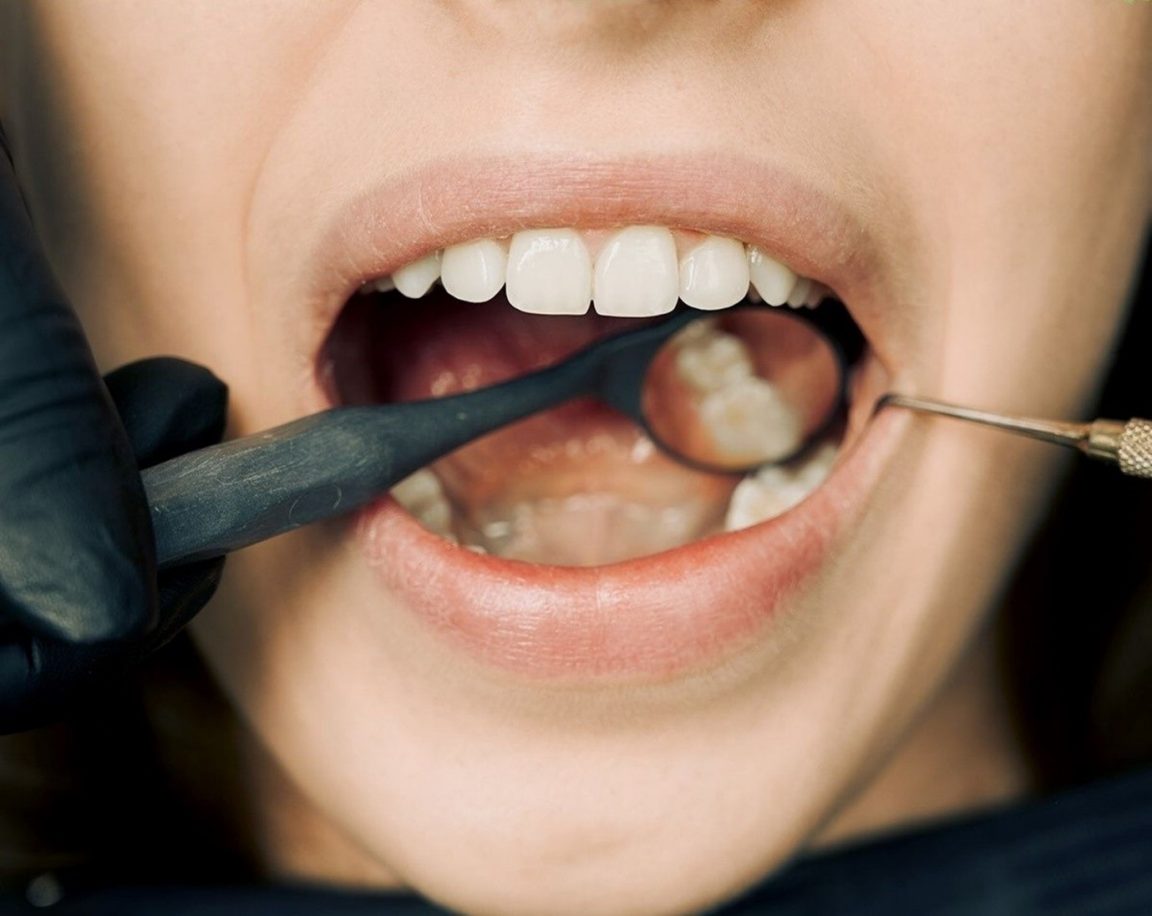 How to Handle Dental Injuries from a Car Crash