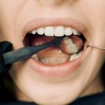 How to Handle Dental Injuries from a Car Crash